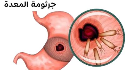مشروبات تقضي على جرثومة المعدة