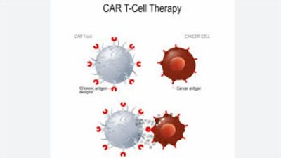 ثورة في علاج الأمراض المناعية: تقنية CAR-T تمنح مريضة شفاءً كاملاً من ثلاث حالات معقدة