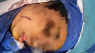 فريق طبي ينقذ مريضة في جراحة دقيقة لاستخراج سكين من قاع الجمجمة داخل طوارئ قصر العيني