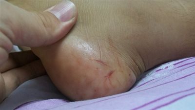 لدغات الثعابين