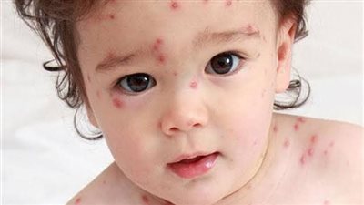 مع ارتفاع درجات الحرارة.. تعرف على أعراض وأسباب مرض الجدري