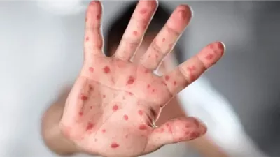 اليابان تقدم 1.5 مليون جرعة لقاح ضد مرض جدري القرود للكونغو الديمقراطية