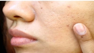بمعجون الأسنان والعسل.. 5 علاجات منزلية للتخلص من البثور في الصيف