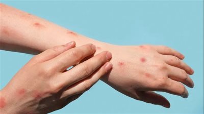 وزارة الصحة الأردنية تعلن عن تسجيل إصابة بفيروس جدري القرود