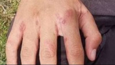بعد تسجيل أول حالة في مصر.. كل ماتريد معرفته عن مرض vexas