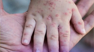 تفشي الحصبة في 25 ولاية أمريكية وتكساس تسجل أعلى عدد إصابات