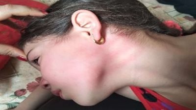 اتهام معلمة بضرب طفلة باستخدام عصا في ديرب نجم