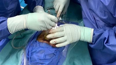 محافظة دمياط: نجاح جراحة معقدة لترميم الوجه والأنف بمستشفى دمياط العام 
