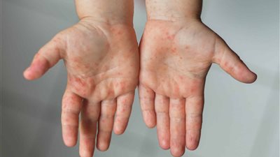 فيروس HFMD يظهر في الجيزة.. كيف تحمي طفلك من المرض؟
