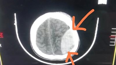 إنجاز طبي في دمياط.. فريق جراحي ينقذ حياة شاب من غيبوبة نزيف المخ بعد حادث مروع