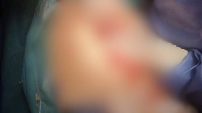 نجاح طبي في مستشفى أبوكبير المركزي في إنقاذ حياة مريضة بحالة حرجة